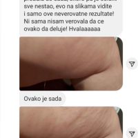 Recenzija strije/celulit 2